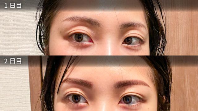 施術ビフォーアフター画像