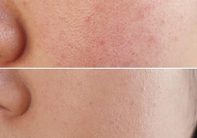 ダイソーのアイデイトのクッションファンデーションはカバー力高め