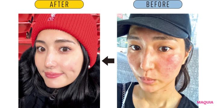 モデル・山賀琴子さんは残念肌からこうして脱出。最悪の状態を救ってくれたコスメも_4