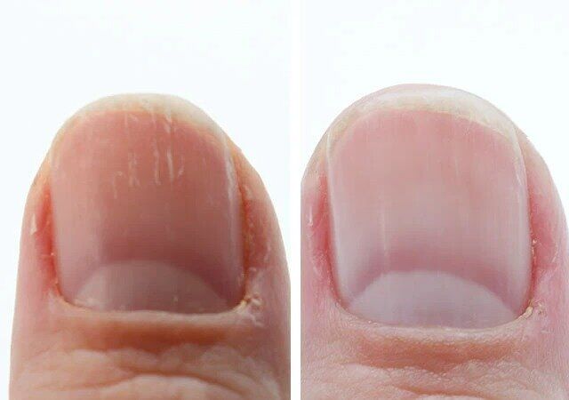 ネイルケアブロック（4ステップ、麦わら）のビフォーアフター