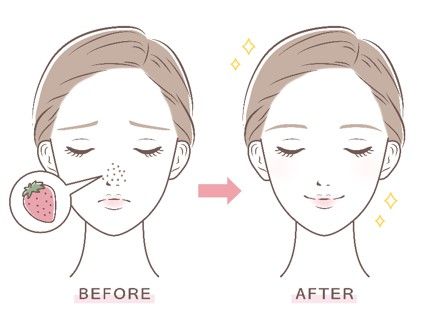 イチゴ鼻イメージ画像