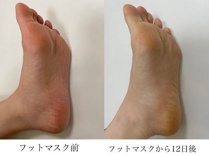 角質を落とすフットマスク使用後２週間の足裏