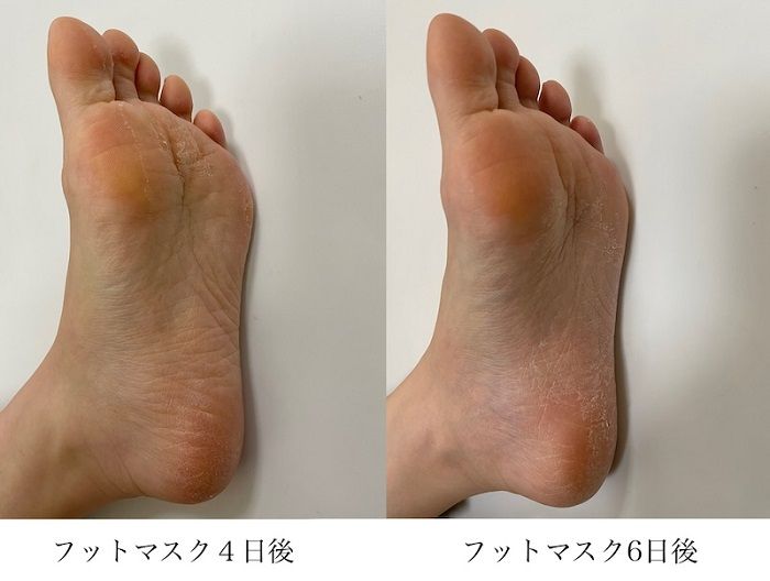 角質を落とすフットマスク使用後の足裏