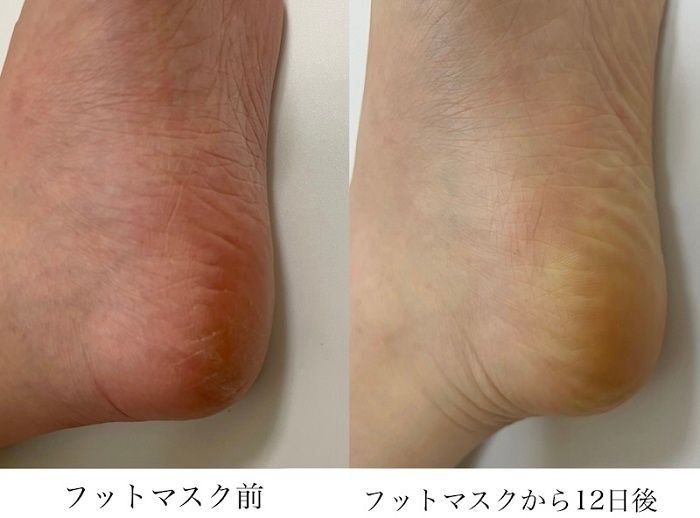 角質を落とすフットマスク使用前と使用後のかかと