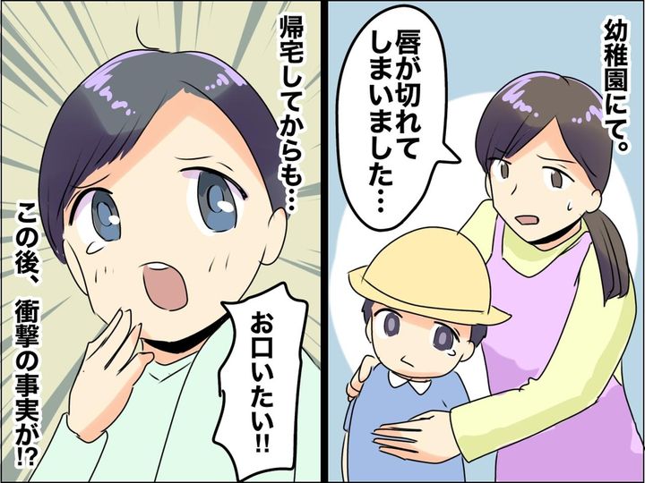 画像: 「ママ、お口が痛い（涙）」【幼稚園でケガをした息子】唇が切れただけかと思いきや → よく見ると！？