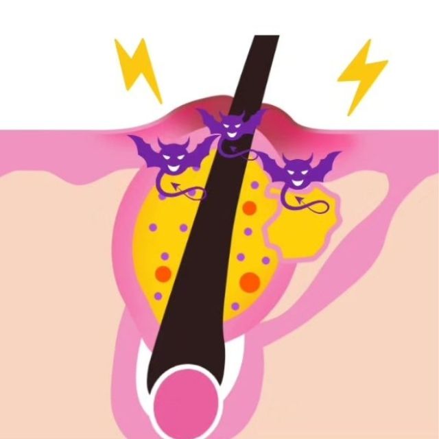 毛穴のつまりや黒ずみ