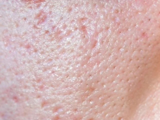 毛穴のつまりや黒ずみ