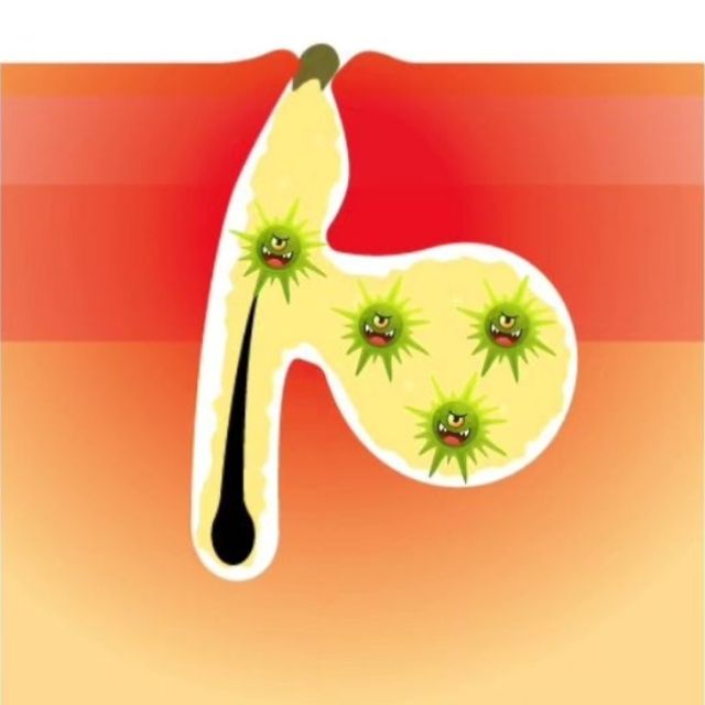 毛穴のつまりや黒ずみ