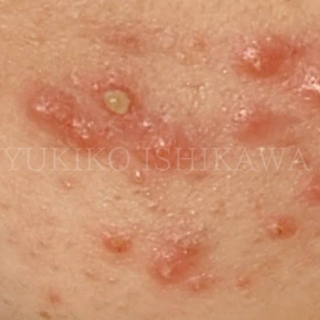 毛穴のつまりや黒ずみ