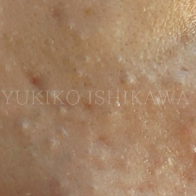 毛穴のつまりや黒ずみ