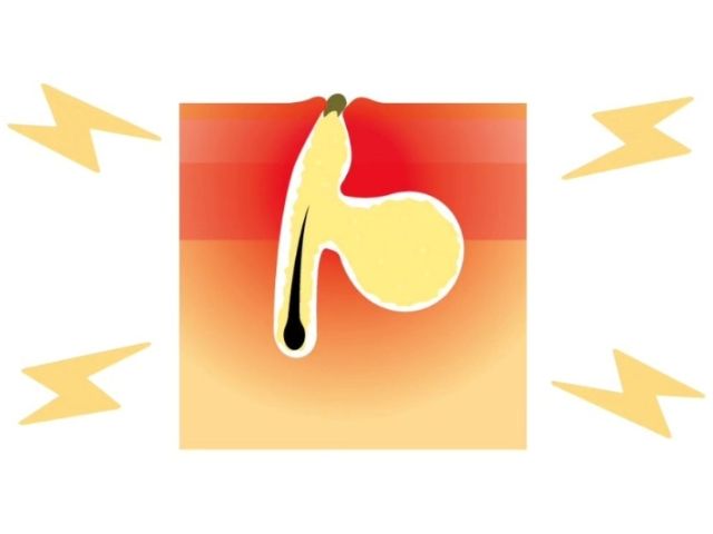 毛穴のつまりや黒ずみ