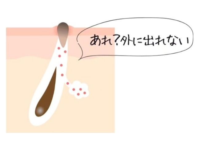 毛穴のつまりや黒ずみ