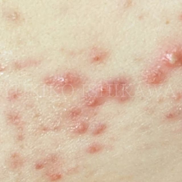 毛穴のつまりや黒ずみ