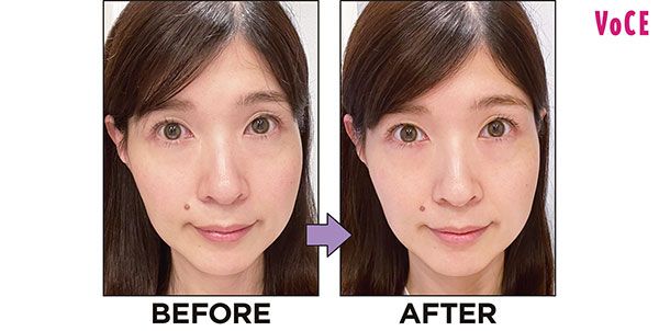 BEFORE→AFTER（リフトケア美顔器 バイタリフトブラシ EH-SP60使用）／YURIさん