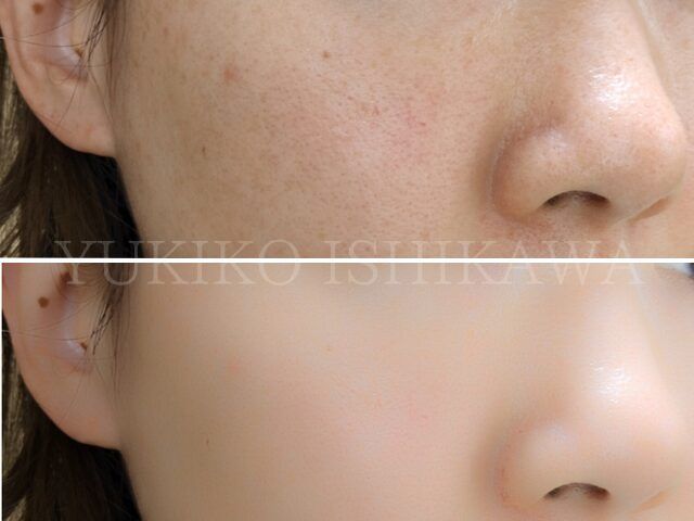 毛穴の専門家 石川ゆき子