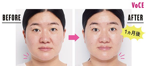 ガンバレルーヤよしこさん BEFORE→AFTER 1ヵ月後 赤み・くすみが減少、首のシワまで薄く