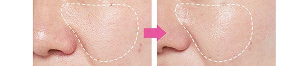 ガンバレルーヤよしこさん BEFORE→AFTER たるみ毛穴にハリが出た