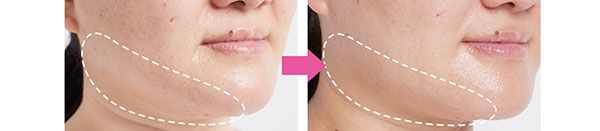 ガンバレルーヤよしこさん BEFORE→AFTER まるで、あごまわり3キロ減