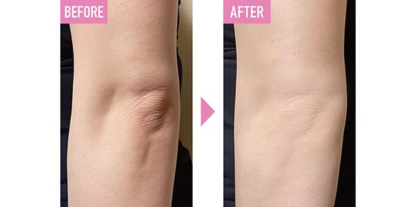 スパオキシデュアルジェル VCプラス使用 BEFORE→AFTER