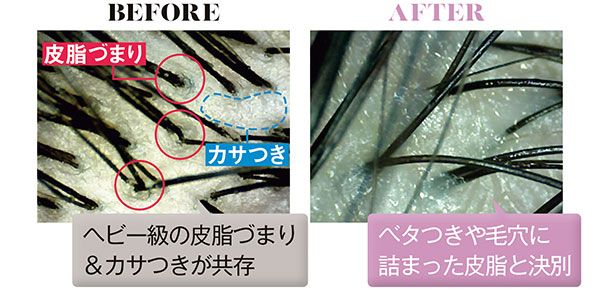 BEFORE ヘビー級の皮脂づまり＆カサつきが共存 皮脂づまり カサつき AFTER ベタつきや毛穴に詰まった皮脂と決別
