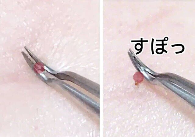 セリア 角栓取りピンセット 角栓取る