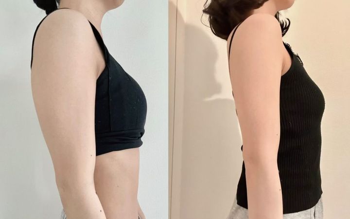 みいこさん 二の腕 ビフォーアフター画像