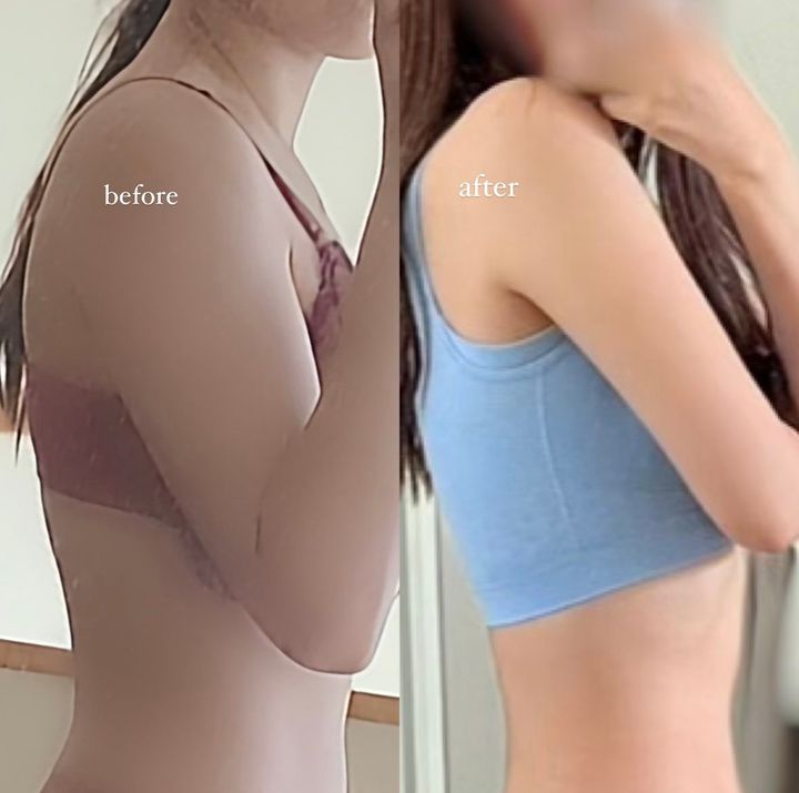 suiさん 二の腕 ビフォーアフター画像