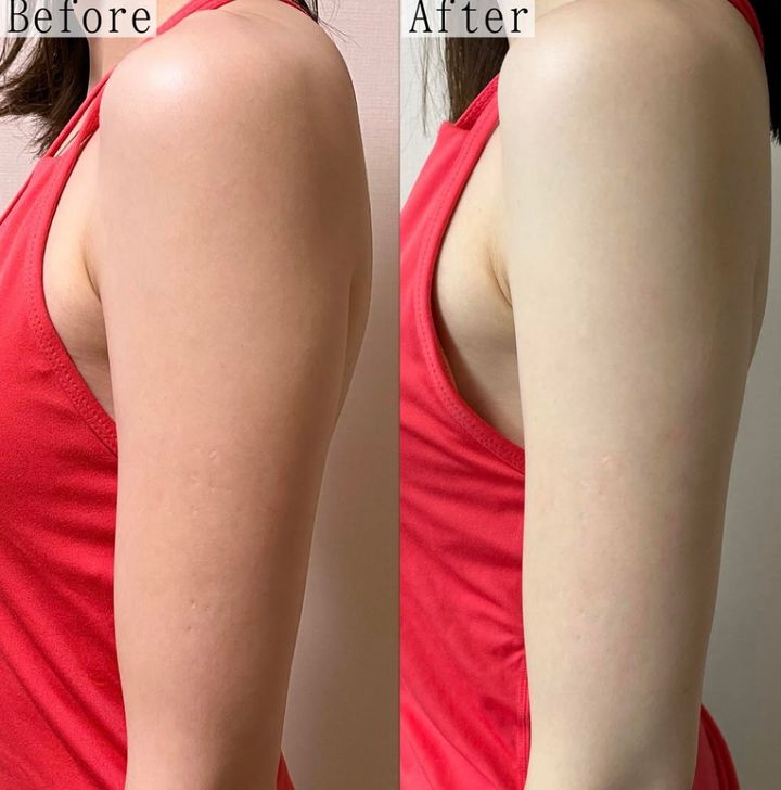 arライター 二の腕 ビフォーアフター画像