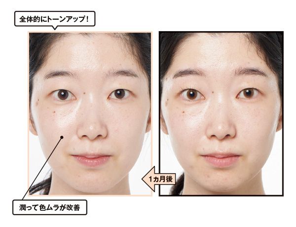 1ヵ月後→全体的にトーンアップ！ 潤って色ムラが改善。