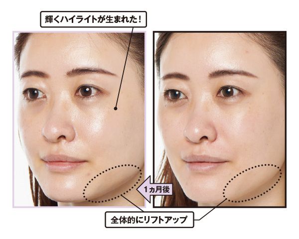 1ヵ月後→輝くハイライトが生まれた！ 全体的にリフトアップ。