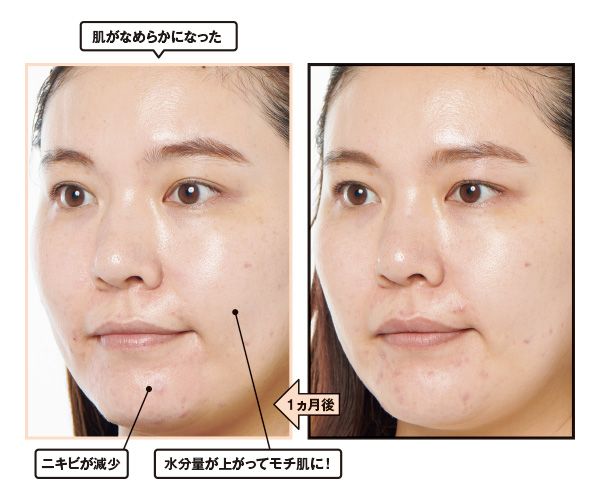 1ヵ月後→肌がなめらかになった。ニキビが減少。水分量が上がってモチ肌に！