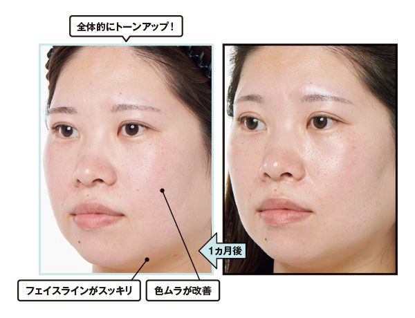 1ヵ月後→全体的にトーンアップ！ フェイスラインがスッキリ。色ムラが改善。