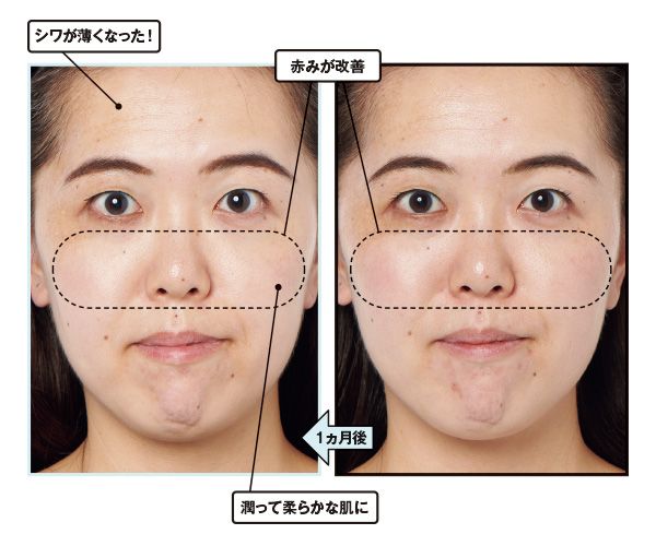 1ヵ月後→シワが薄くなった！ 赤みが改善。潤って柔らかな肌に。