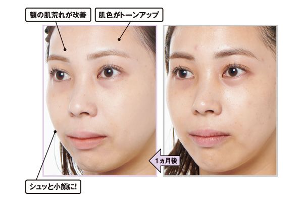 1ヵ月後→額の肌荒れが改善。肌色がトーンアップ。シュッと小顔に！