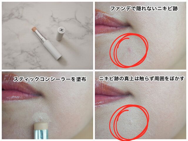 ニキビ跡 スティックタイプでカバー