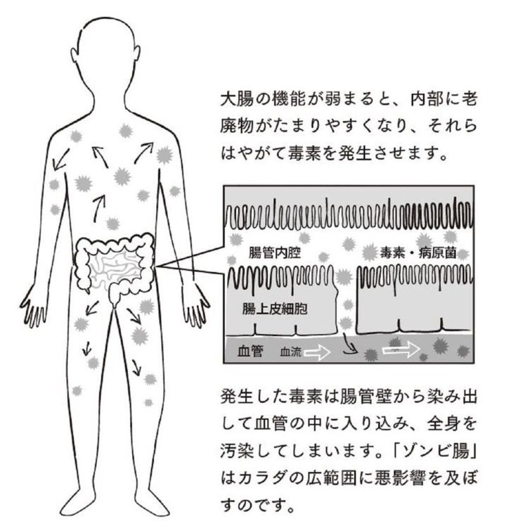 腸に老廃物が溜まり、全身の不調を引き起こすゾンビ腸