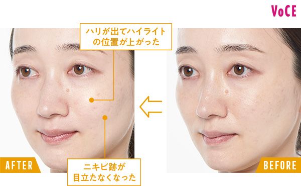 BEFORE→AFTER ハリが出てハイライトの位置が上がった ニキビ跡が目立たなくなった