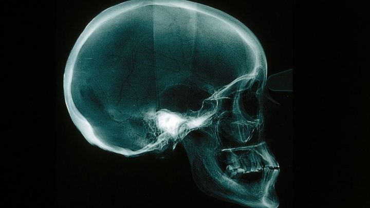 合計7カ所の顔面骨折…J1アビスパ福岡GK永石拓海がInstagramに痛々しいレントゲン写真を公開