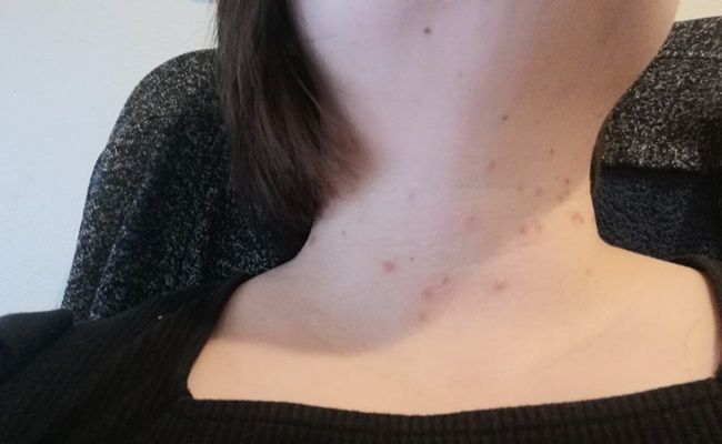 首元にできたイボ