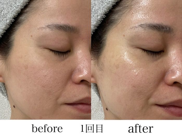 シートマスクを顔に装着する１回目の横顔