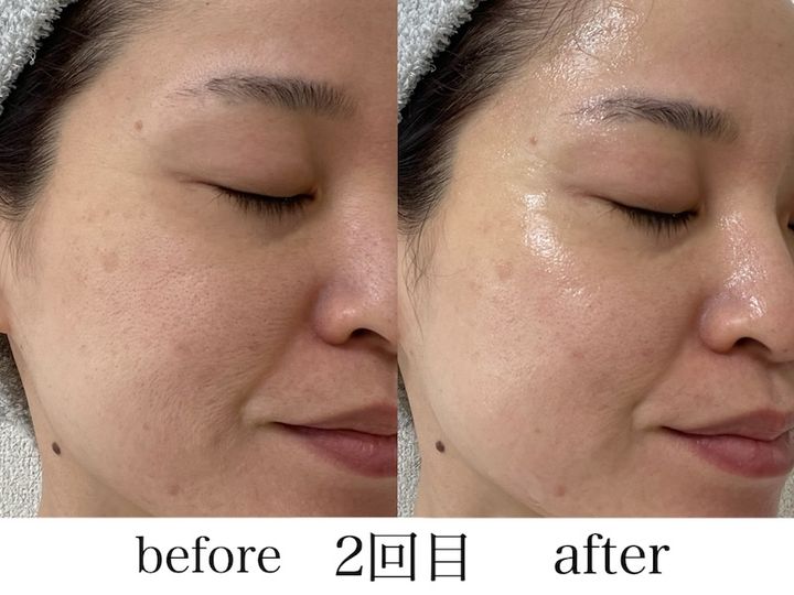 シートマスクを顔に装着する２回目の横顔