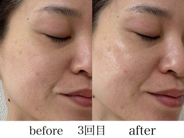 シートマスクを顔に装着する３回目の横顔