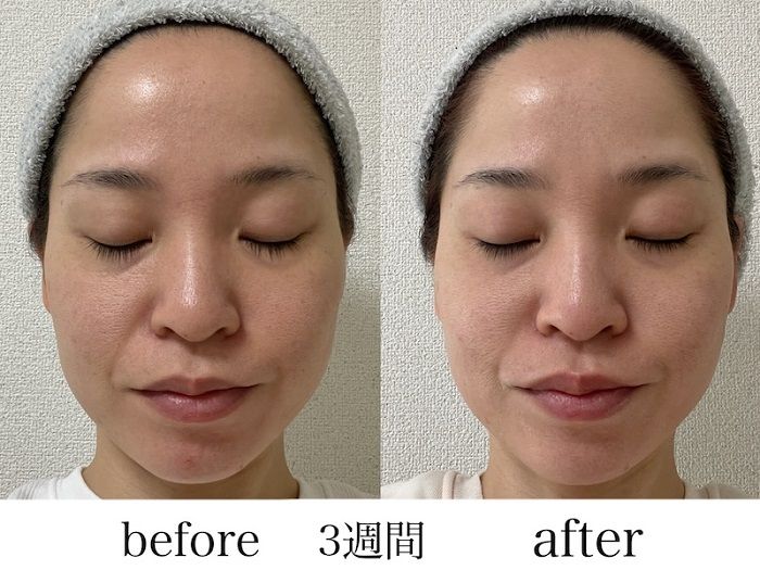 シートマスクを顔に装着する３週間の比較