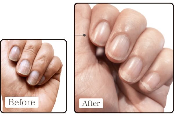 Before→After 1ヵ月しっかりケアしてツヤが出た爪