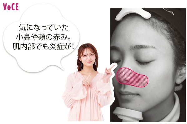 気になっていた小鼻や頰の赤み。肌内部でも炎症が！