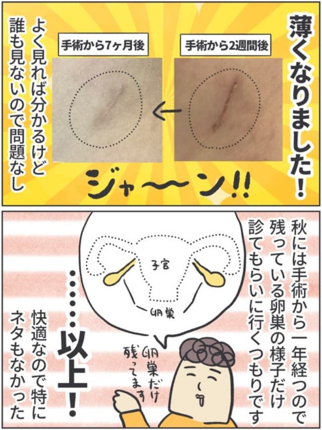 子宮全摘記録14