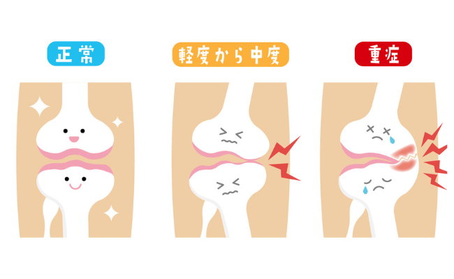 「変形性膝関節症」の原因からセルフケア・受診のポイント