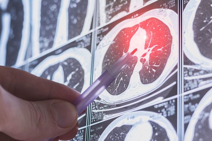 胸部CT画像の一部を指さす医師の手元