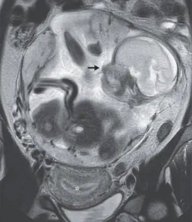 腹腔で発育していた胎児の画像（その下の星印で示されたのが子宮）