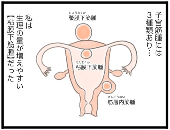 #子宮筋腫ができたのは私のせい？ 7